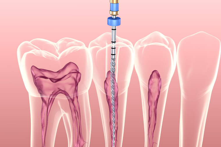 Konservierende Zahnheilkunde mit Wurzelbehandlung in der Zahnarztpraxis Dr. med. dent. Uta Löffler in Zittau