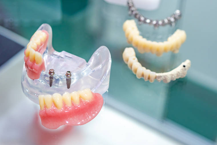Implantatprothetik in der Zahnarztpraxis Dr. med. dent. Uta Löffler in Zittau