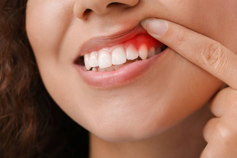 Parodontis / Periodontitisbehandlung in der Zahnarztpraxis Dr. med. dent. Uta Löffler in Zittau