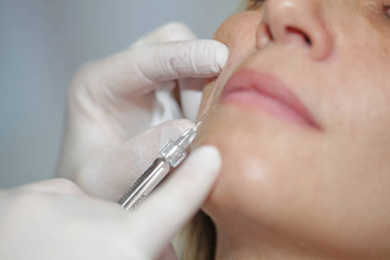Faltenunterspritzung im mundnahen Bereich in der Zahnarztpraxis Dr. med. dent. Uta Löffler in Zittau